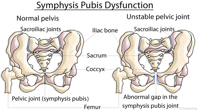 Pubic Symphysis Dysfucntion