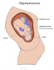 Oligohydramnios Low Amniotic Fluid Pictures