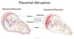 Placental Abruption Pictures