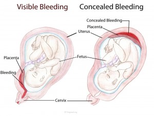 Placental Abruption Bleeding