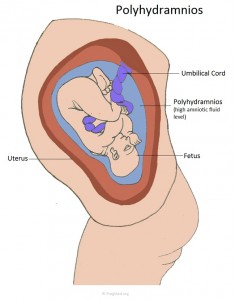 Polyhydramnios High Amniotic Fluid Pictures