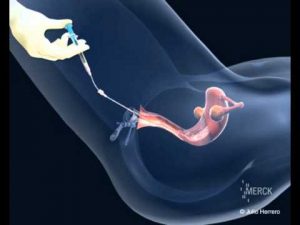 IUI