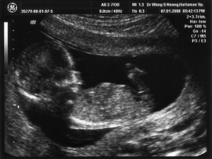 14 Weeks Pregnant Ultrasound Picture