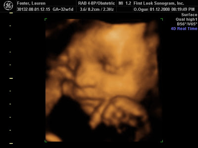 32 Weeks Pregnant Ultrasound Picture