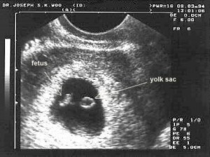 6 Weeks Pregnant Ultrasound Picture