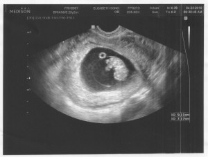 9 Weeks Pregnant Ultrasound Photo
