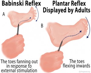 Babinski Reflex