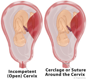 Cervical Cerclage