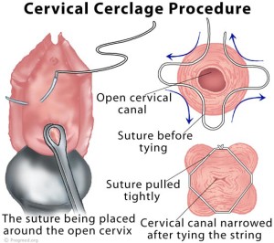 Cervical Cerclage Procedure
