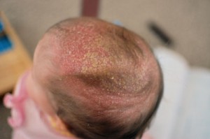 Cradle Cap Image