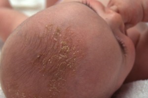 Cradle Cap Picture
