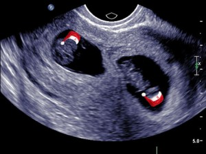 Christmas Card Twin Pregnancy Announcement
