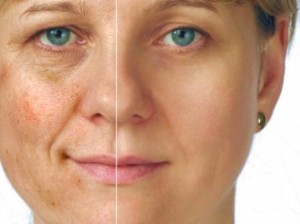 Melasma During Pregnancy Picture