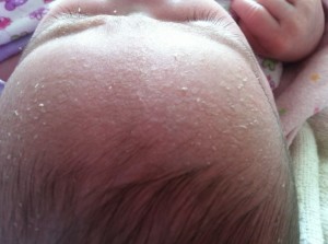 Picture of Cradle Cap