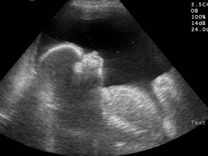 Polyhydramnios Ultrasound Picture
