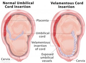 Velamentous Cord Insertion