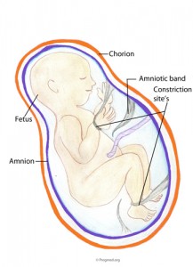 Amniotic Band Syndrome