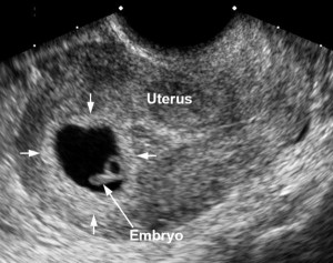 Amniotic Sac Ultrasound