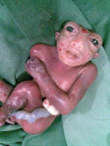 Anencephaly