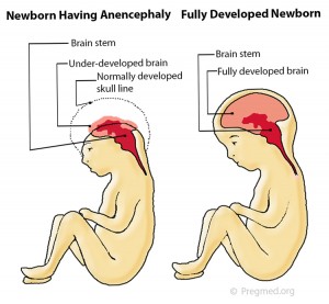Anencephaly Pictures