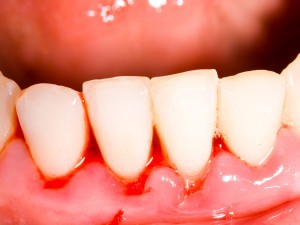 Bleeding Gums during Pregnancy