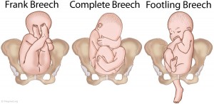 Breech Positions