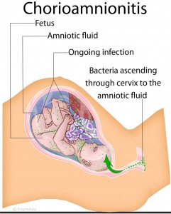 Chorioamnionitis