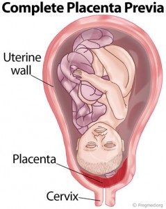 Complete Placenta Previa