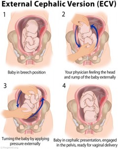 External Cephalic Version