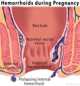 Hemorrhoids during Pregnancy