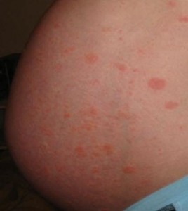 Hives During Pregnancy