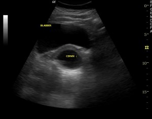 Incompetent Cervix Ultrasound