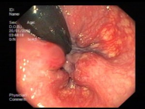 Internal Hemorrhoids