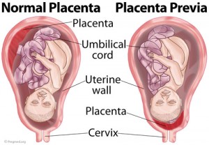 Placenta Previa