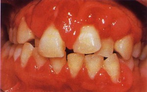 Pregnancy Gingivitis
