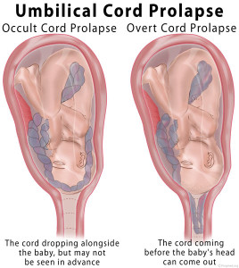 Prolapsed Cord