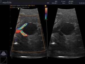 Umbilical Cord Prolapse Ultrasound