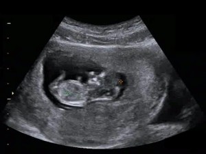 11 Weeks Pregnant Ultrasound Image