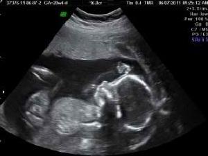 21 Weeks Pregnant Ultrasound Picture