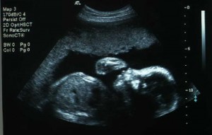 24 Weeks Pregnant Ultrasound Picture