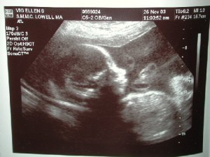 25 Weeks Pregnant Ultrasound Picture