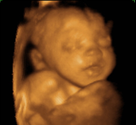 40 Weeks Pregnant Ultrasound Picture