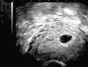 5 Weeks Pregnant Ultrasound Image