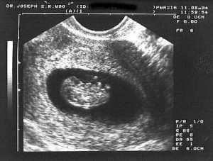 Week 8 Pregnancy Ultrasound